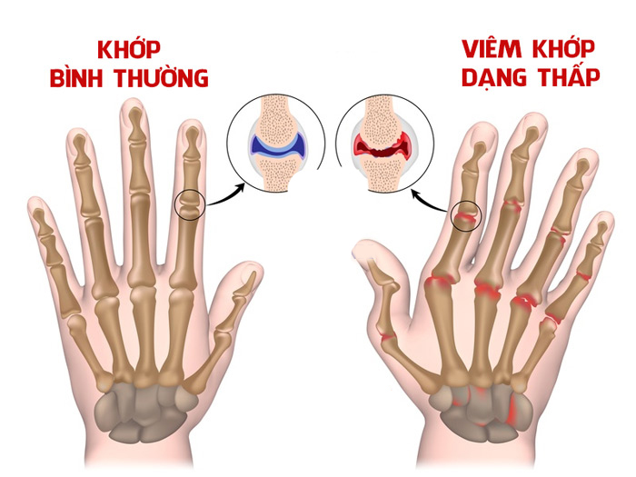 phan-biet-cac-loai-viem-khop-dang-thap-va-phuong-phap-dieu-tri-phan-1-2.jpg (145 KB)