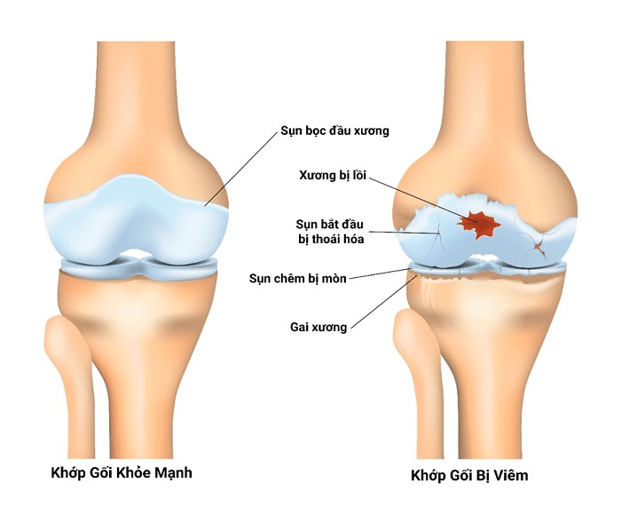 phan-biet-cac-loai-viem-khop-dang-thap-va-phuong-phap-dieu-tri-phan-2-2.jpg (70 KB)